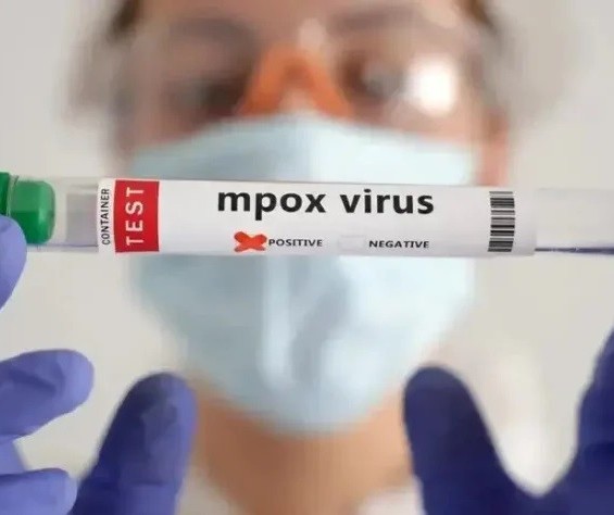 Maringá investiga dez casos suspeitos de mpox